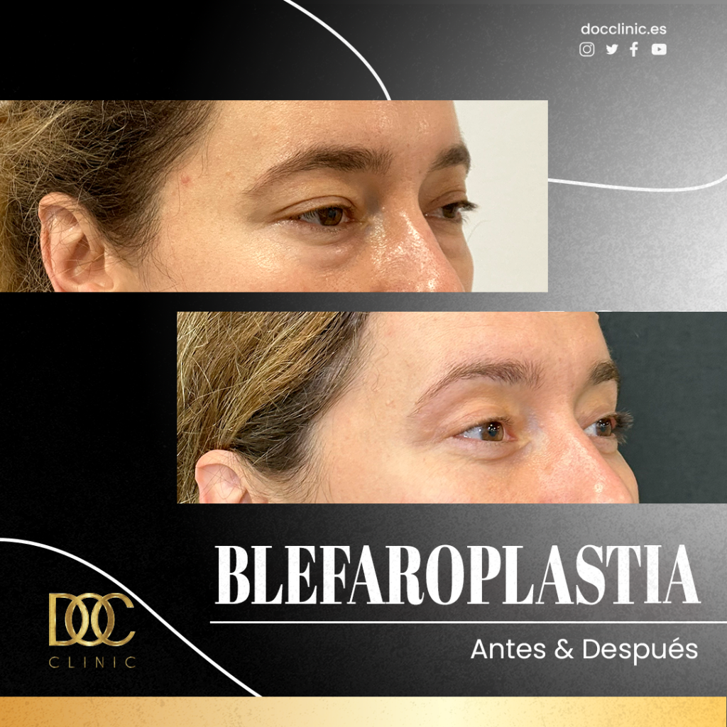 AD Doc clinic Blefaroplastia2#3