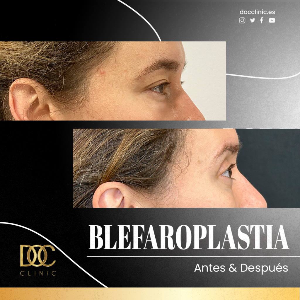 AD Doc clinic Blefaroplastia2#4