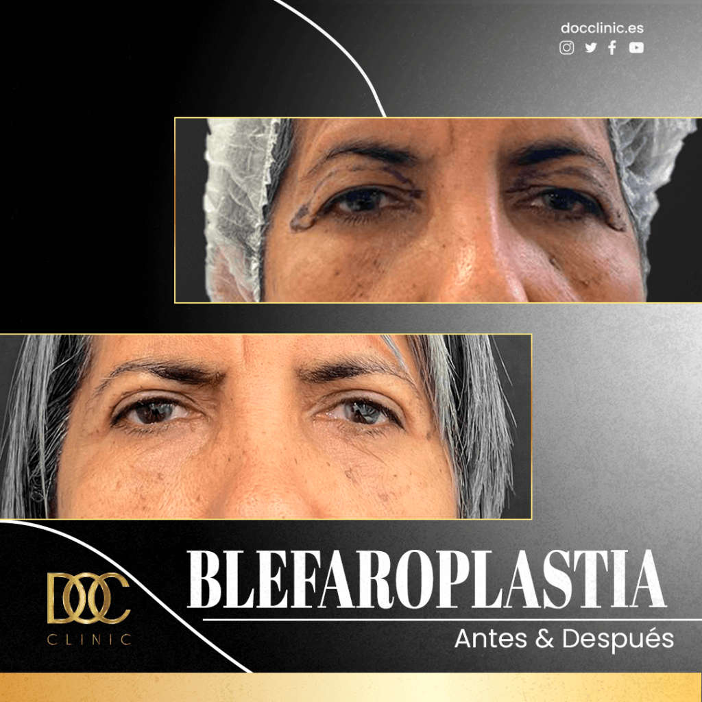 AD Doc clinic Blefaroplastia Ochoa2#1 (1)