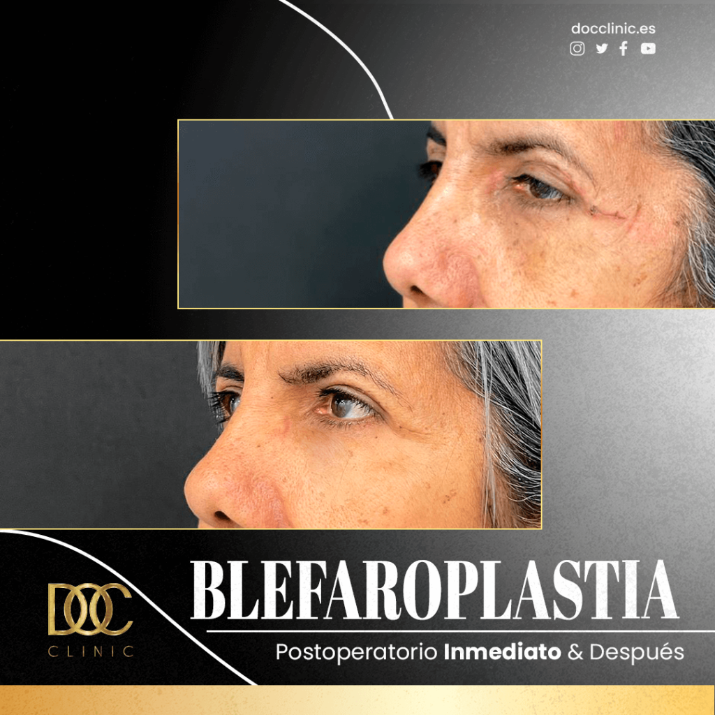 AD Doc clinic Blefaroplastia Ochoa2#2 (1)