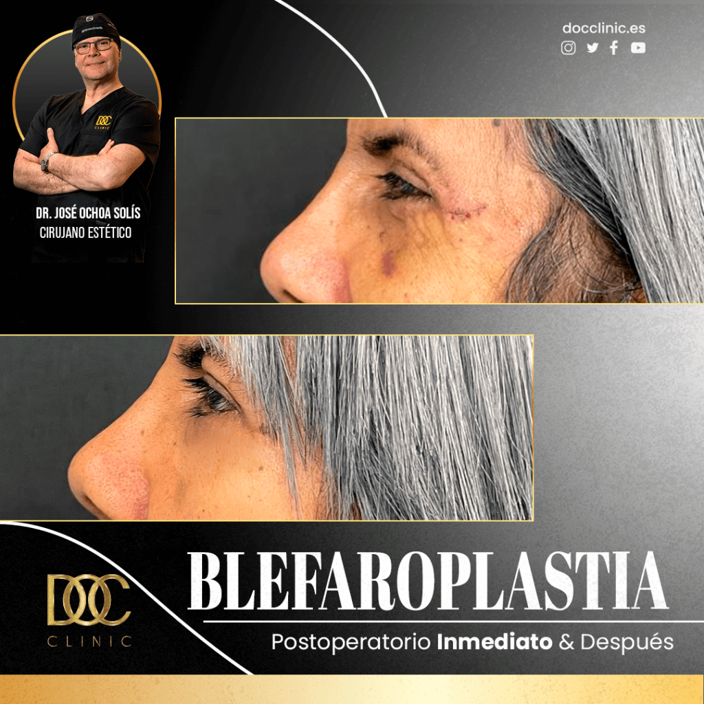 AD Doc clinic Blefaroplastia Ochoa2#3 (1)