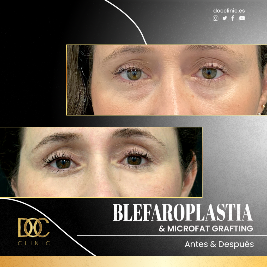 AD 2943-1 Blefaroplastia