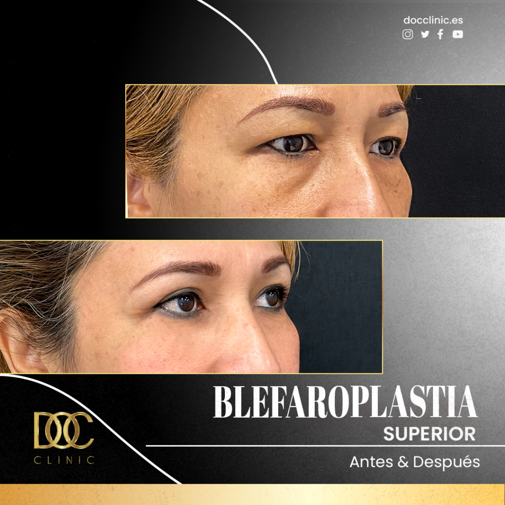 AD 3059 (Blefaroplastia)-3