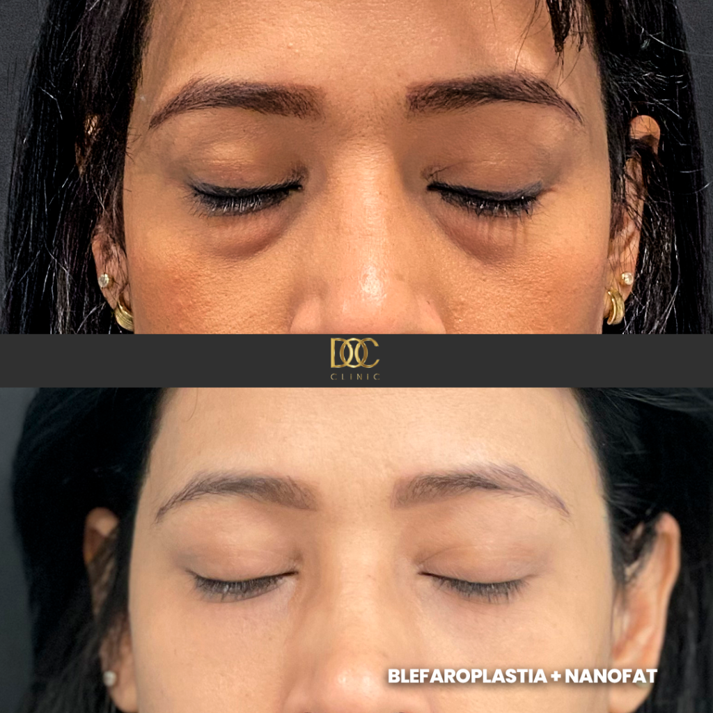 DOC CLINIC AD (Blefaroplastia 3554)NF_2