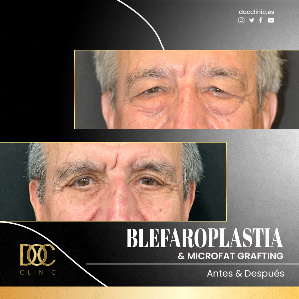 DOC CLINIC Caso 2255 - Blefa + Microfat-1