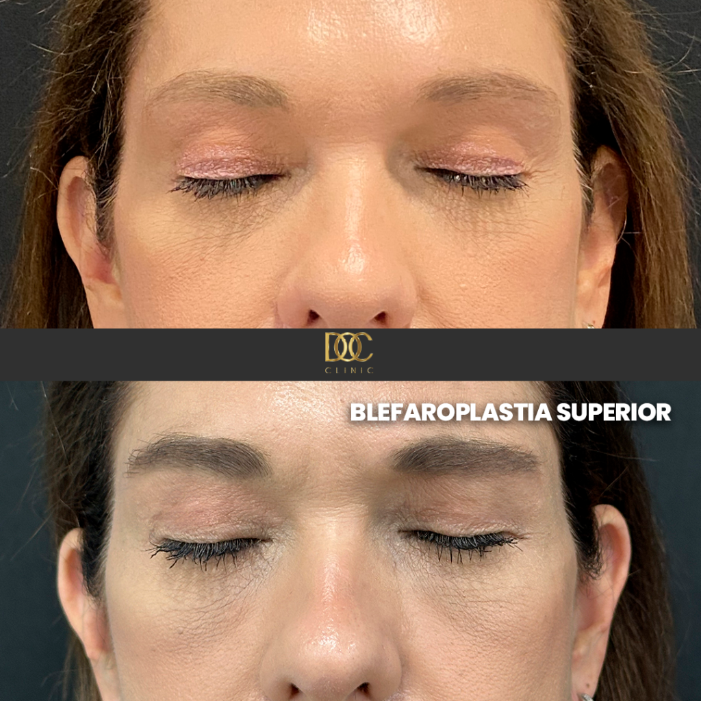 DOC CLINIC AD (Blefaroplastia)-1