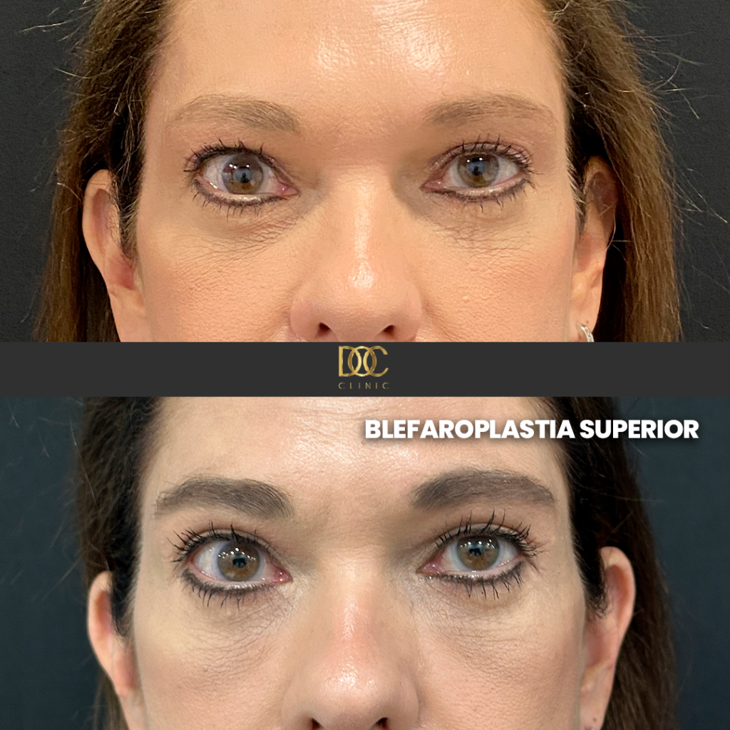 DOC CLINIC AD (Blefaroplastia)-2