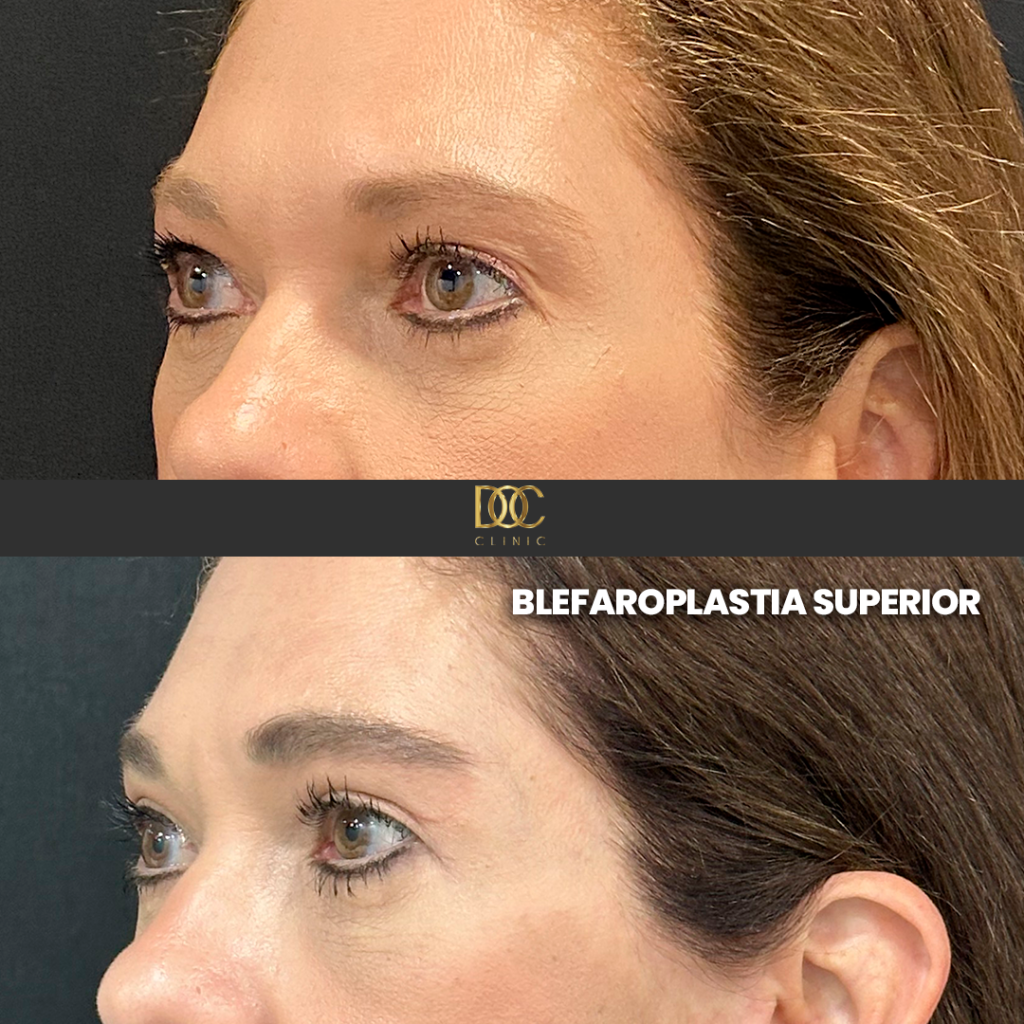 DOC CLINIC AD (Blefaroplastia)-3