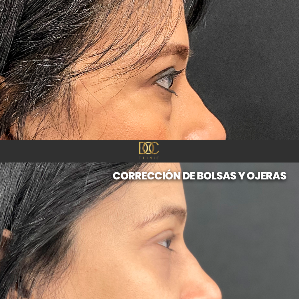 DOC CLINIC AD (Blefaroplastia 3554)NF_3