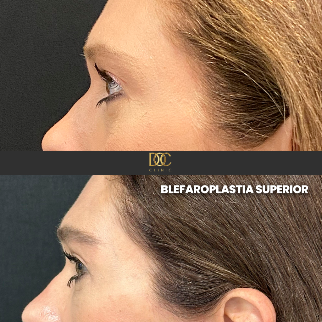 DOC CLINIC AD (Blefaroplastia)-4