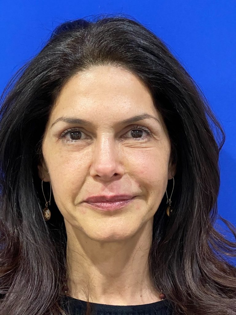 Antes y después del minilifting facial
