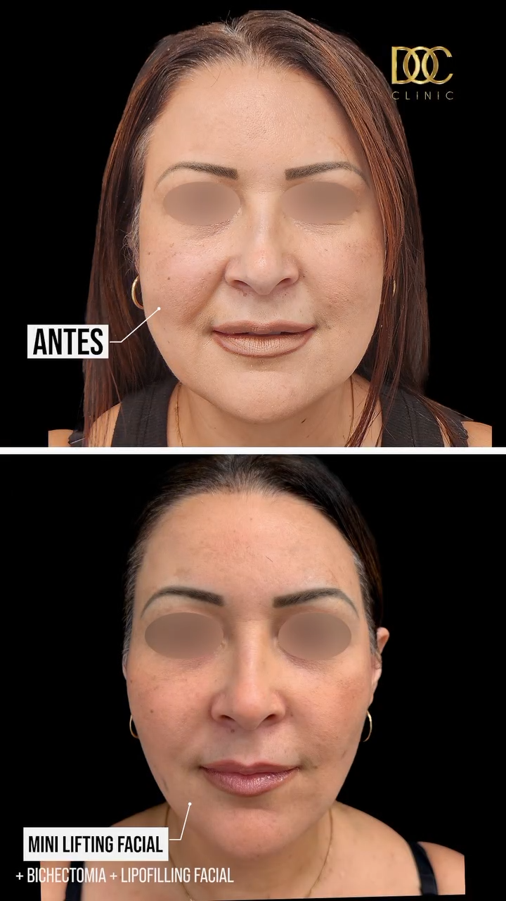 Minilifting facial en Madrid