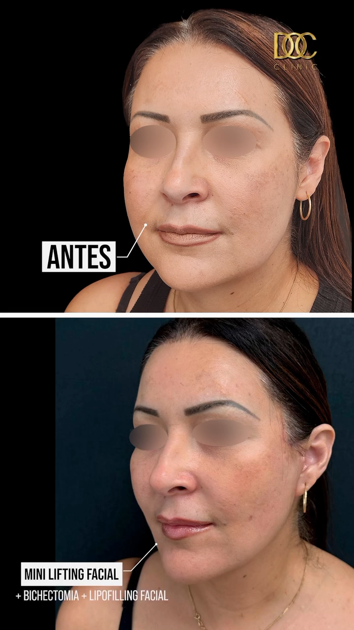 minilifting facial 2