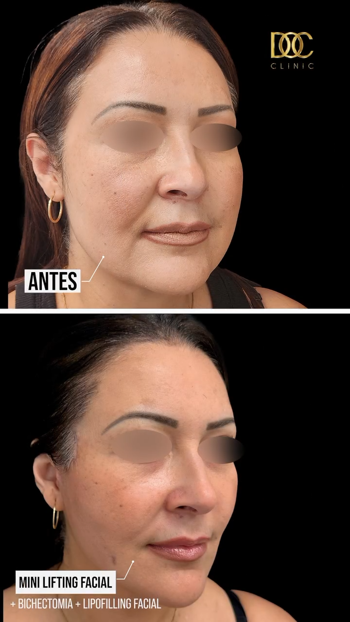 minilifting facial 3