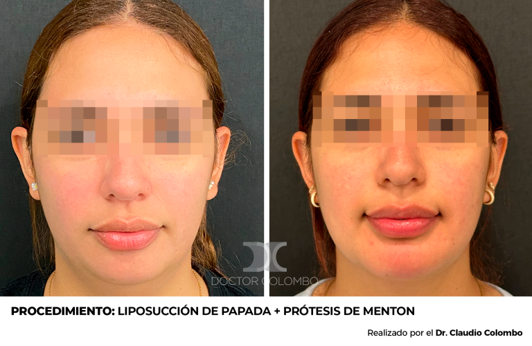 Frontal (10)