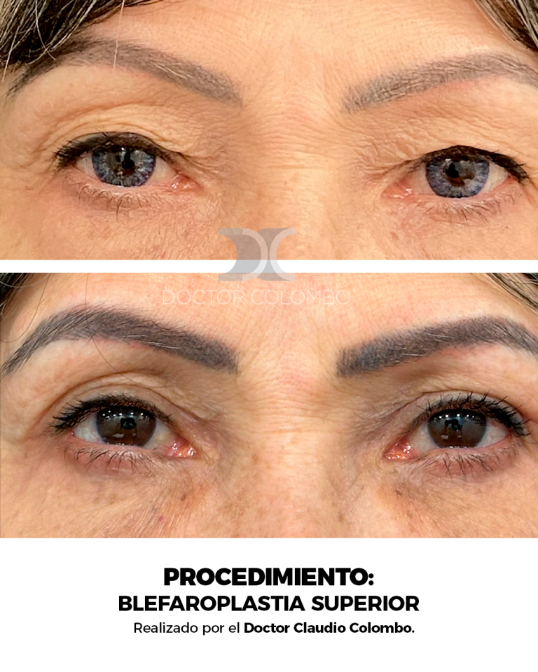 Frontal (2)