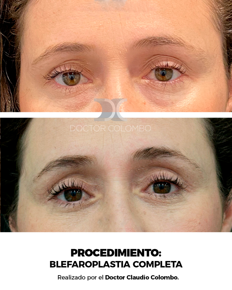 Frontal (3)
