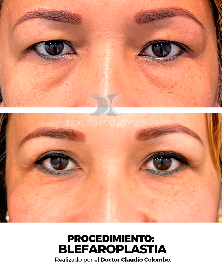Frontal (4)