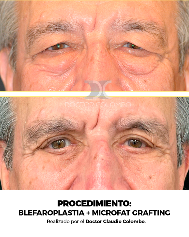 Frontal (5)