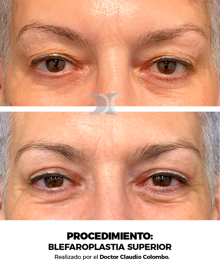 Frontal (6)