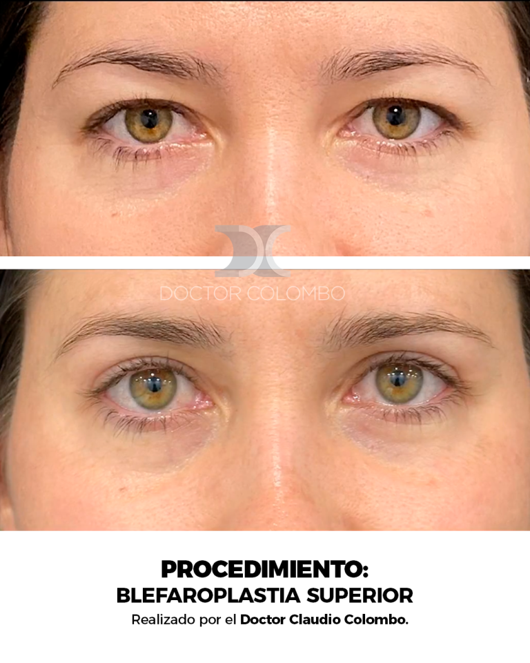 Frontal (7)