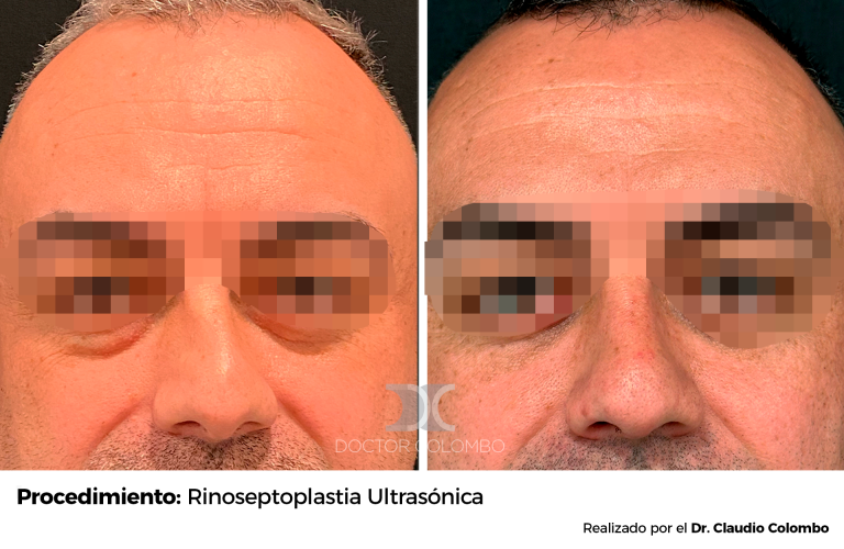 Frontal (9)