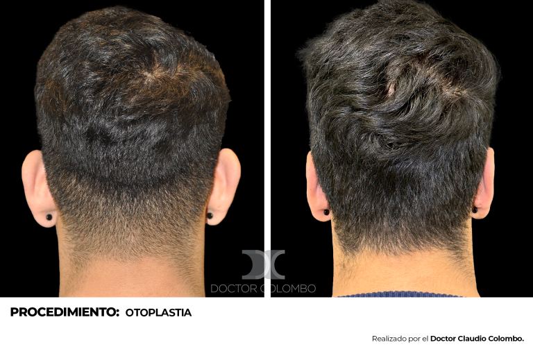 OTOPLASTIA 1056 - 1