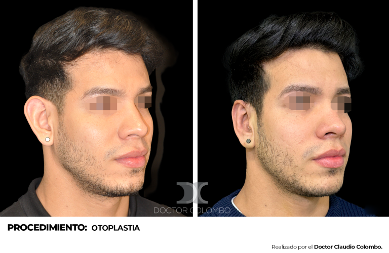 OTOPLASTIA 1056 - 2
