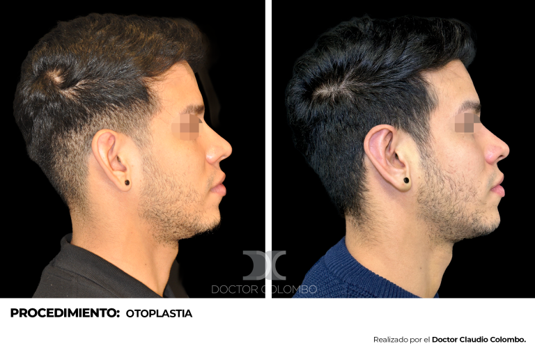 OTOPLASTIA 1056 - 3_